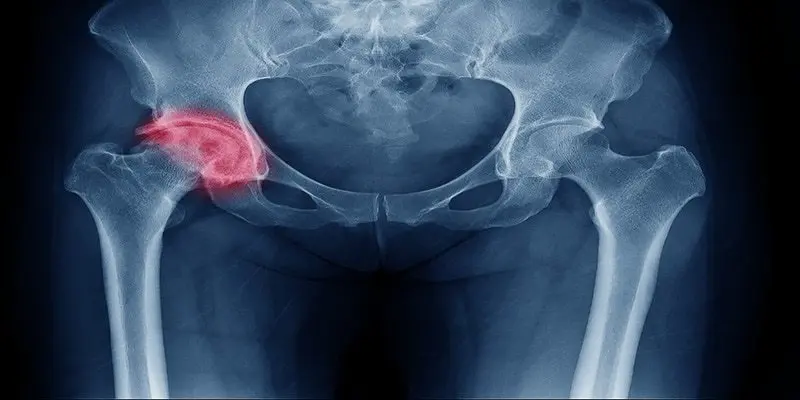 Radiografía de una fractura de cadera