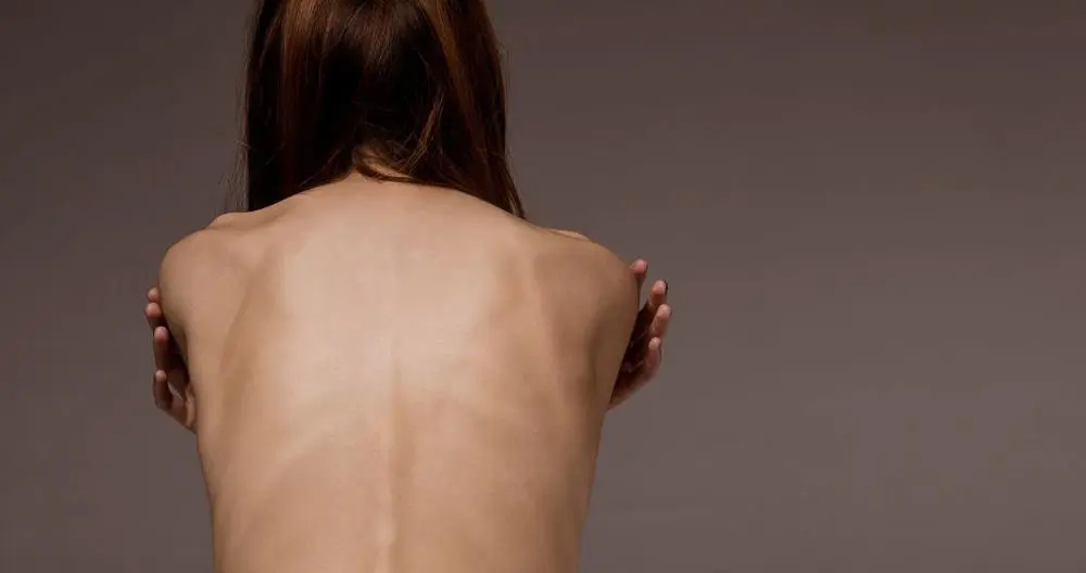 anorexia-bulimia-jovenes