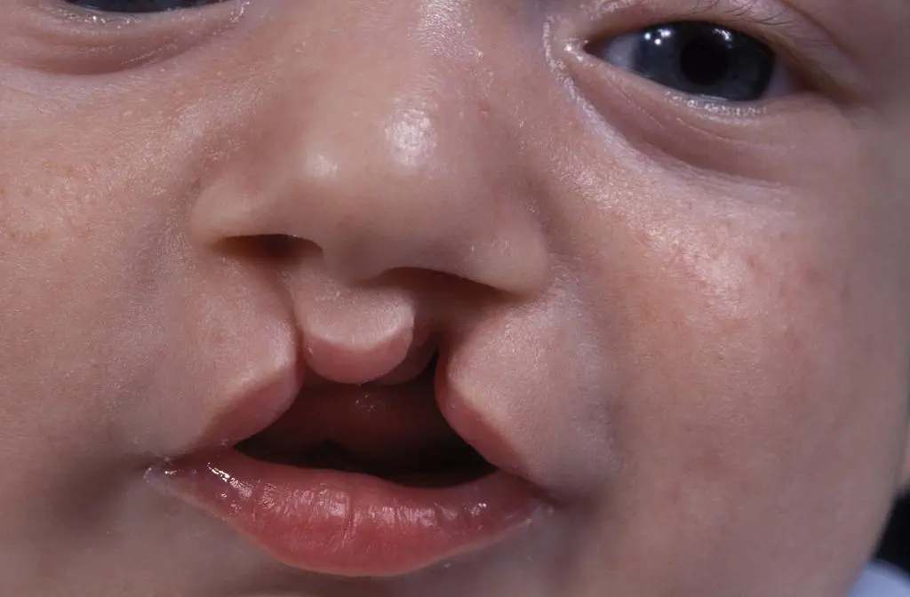 labio leporino