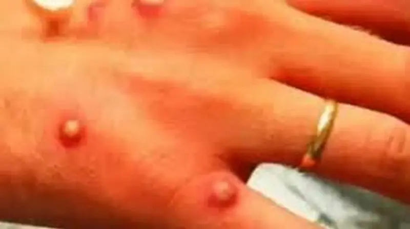 Un contagiado de viruela del mono muestra su mano, Foto Telemadrid