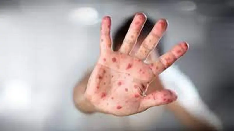 Un mano con viruela. Foto cronista.com