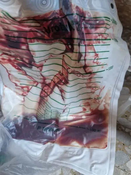 Foto cedida por la familia de la bolsa del paciente con sangre