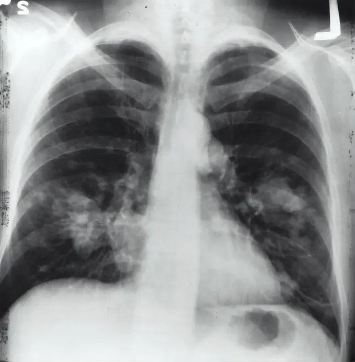 Radiografía cáncer