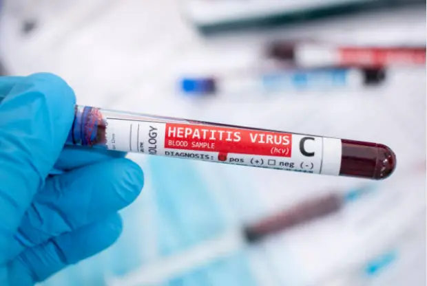 Hepatitis C. Fotografía de archivo