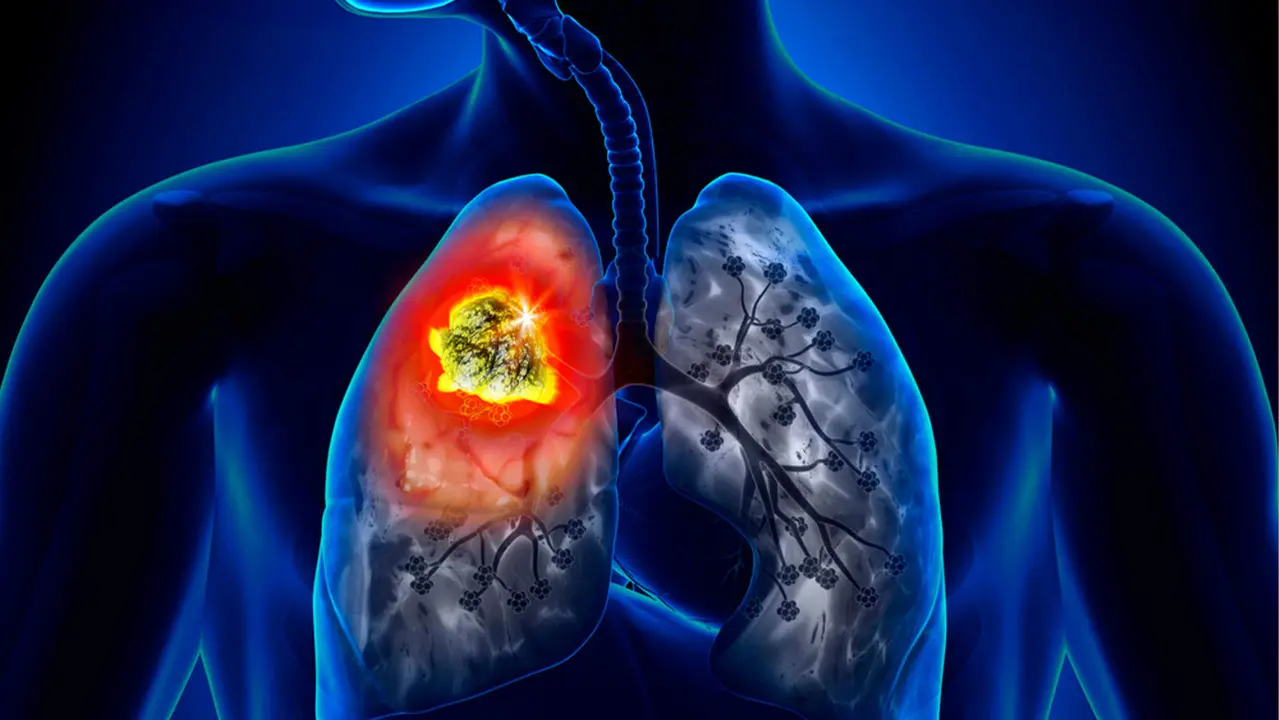 cancer pulmon