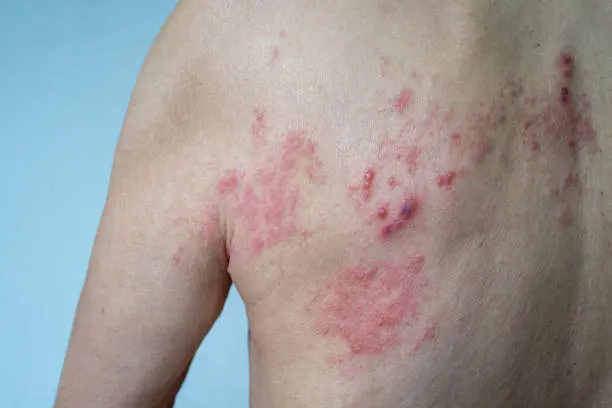 Herpes Zoster