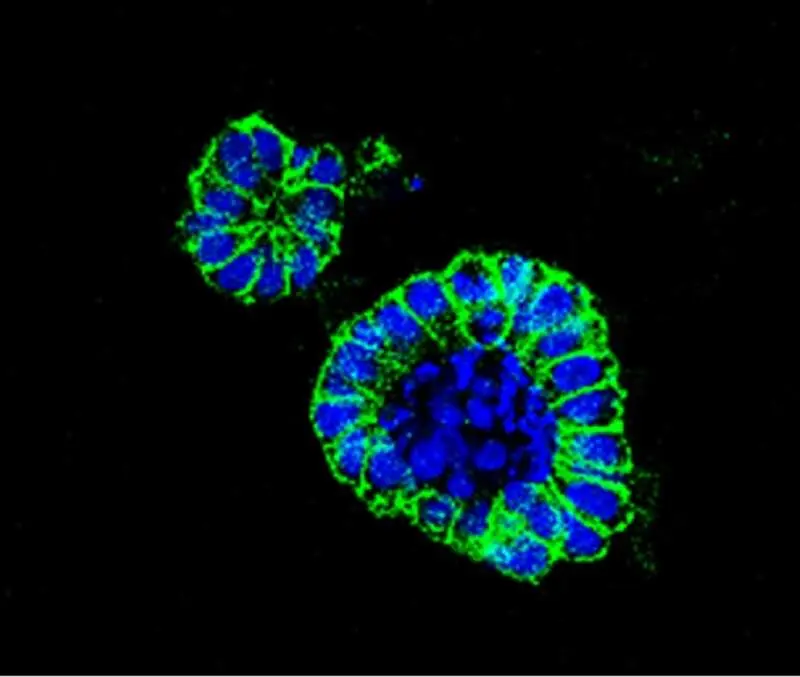 Organoide de cáncer de colon. CIC