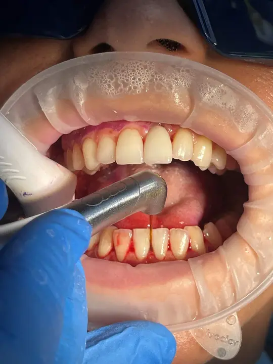 Fotografía clínica de un dispositivo láser facilitado por la Clínica Dental Odontic by Dra. María J. Pérez