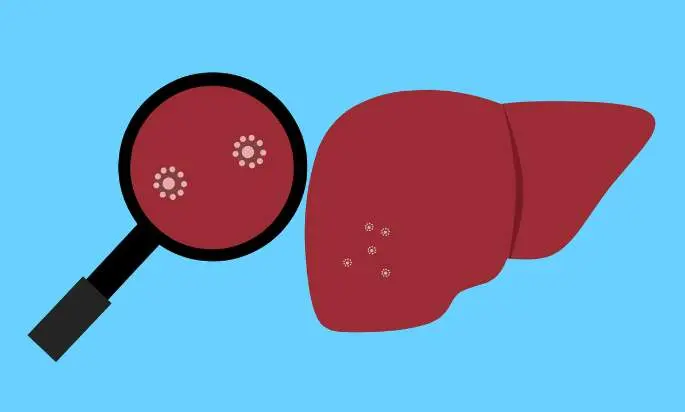 Hepatitis A