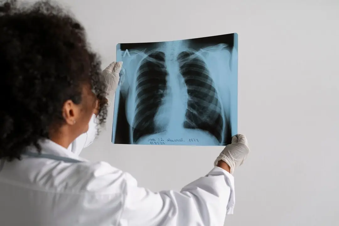 Tuberculosis Archivo