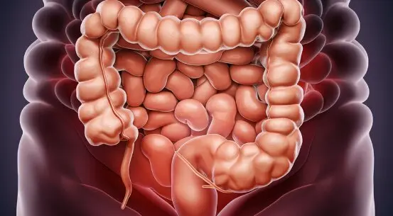Cáncer de colon. Foto de Archivo