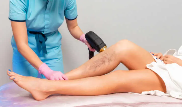 varices