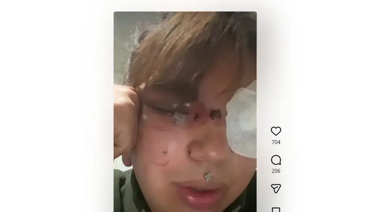 Bianca Fern&aacute;ndez muestra las secuelas tras la agresi&oacute;n