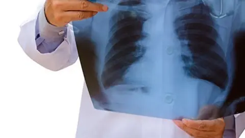 Radiografía simple de tórax