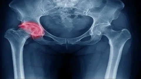 Radiografía de una fractura de cadera