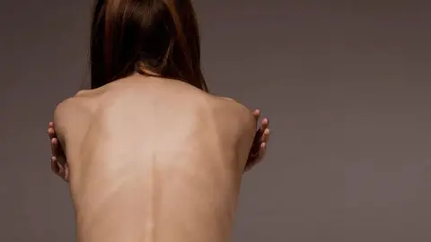 anorexia-bulimia-jovenes