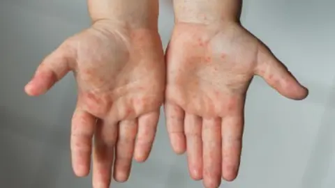 Erupciones cutáneas. Fotografía de archivo