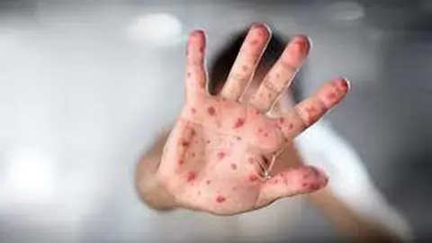 Un mano con viruela. Foto cronista.com