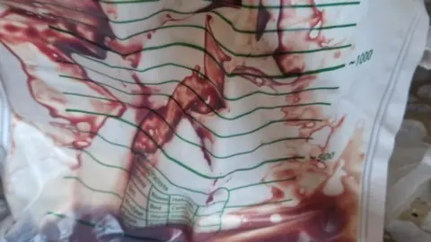 Foto cedida por la familia de la bolsa del paciente con sangre