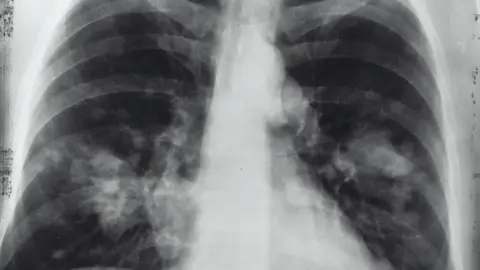 Radiografía cáncer
