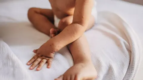 Varicela. fotografía de archivo