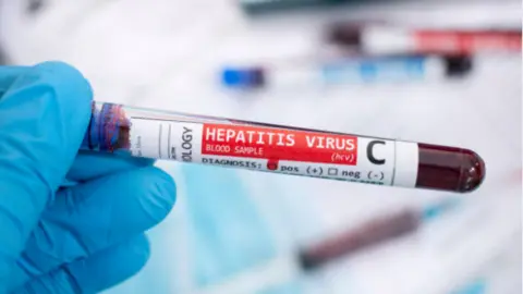 Hepatitis C. Fotografía de archivo