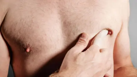 Ca´ncer de mama masculino. Fotografía de archivo