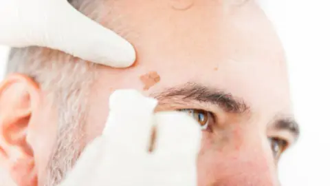 Melanoma. Fotografía de archivo