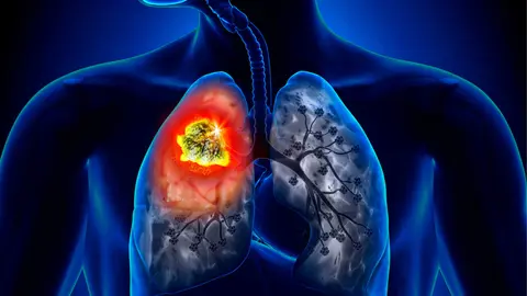 cancer pulmon