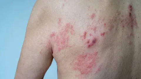 Herpes Zoster