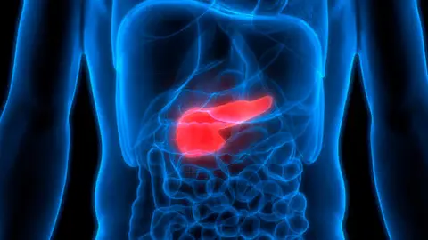 cáncer de páncreas