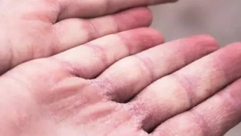 Esclerodermia. Fotografía de archivo