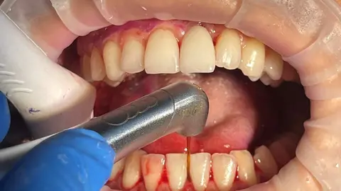 Fotografía clínica de un dispositivo láser facilitado por la Clínica Dental Odontic by Dra. María J. Pérez