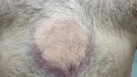 agricultor afectado por las pelotas de goma. IMAGEN CEDIDA