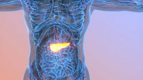 Cáncer de páncreas