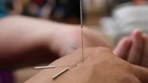 Acupuntura. Foto de archivo