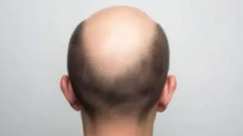 Calvicie. Foto de archivo.