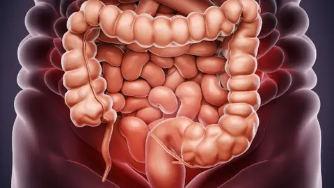 Cáncer de colon. Foto de Archivo