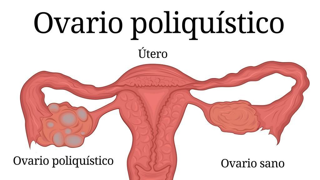 Ovario-poliquistico.jpg