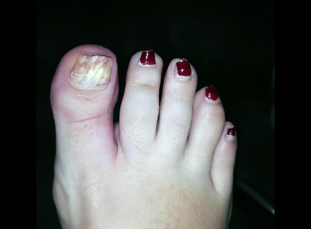 Onicodistrofia total por abuso del esmalte permanente. Fotografía: Colegio Oficial de Podólogos de Castilla y León