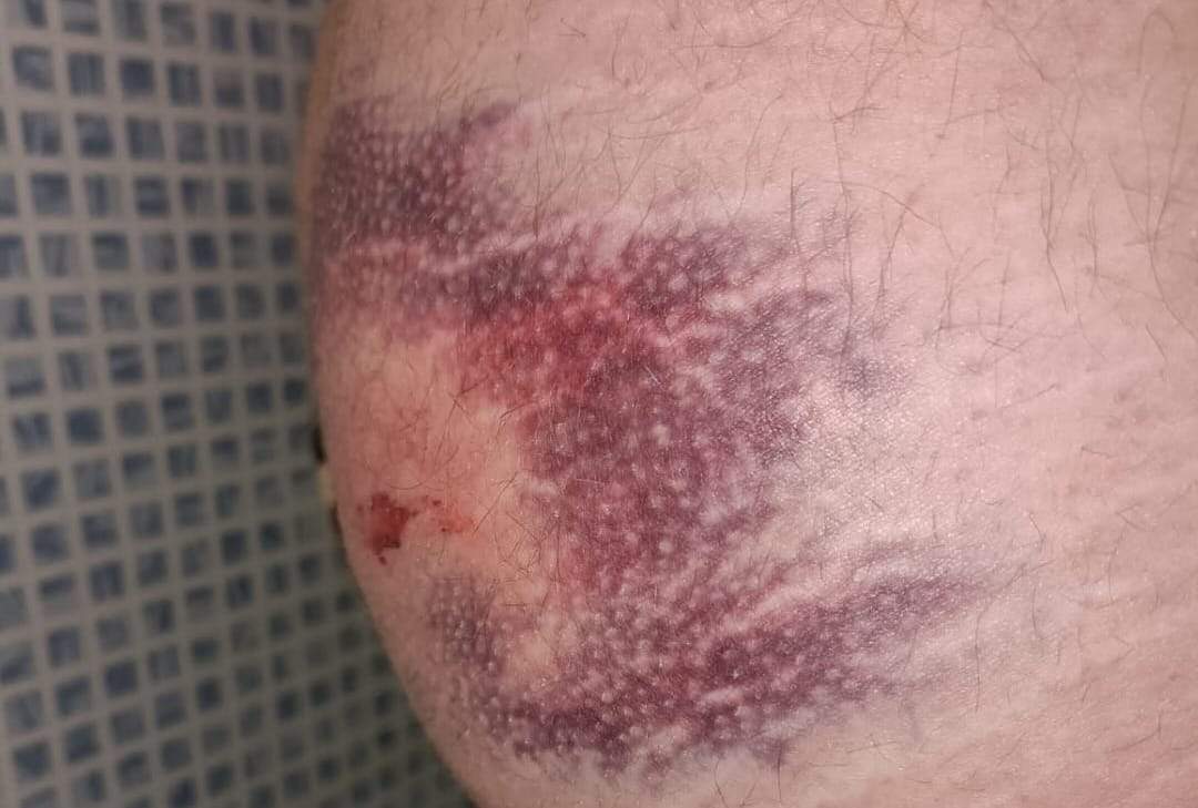 agricultor afectado por las pelotas de goma. IMAGEN CEDIDA
