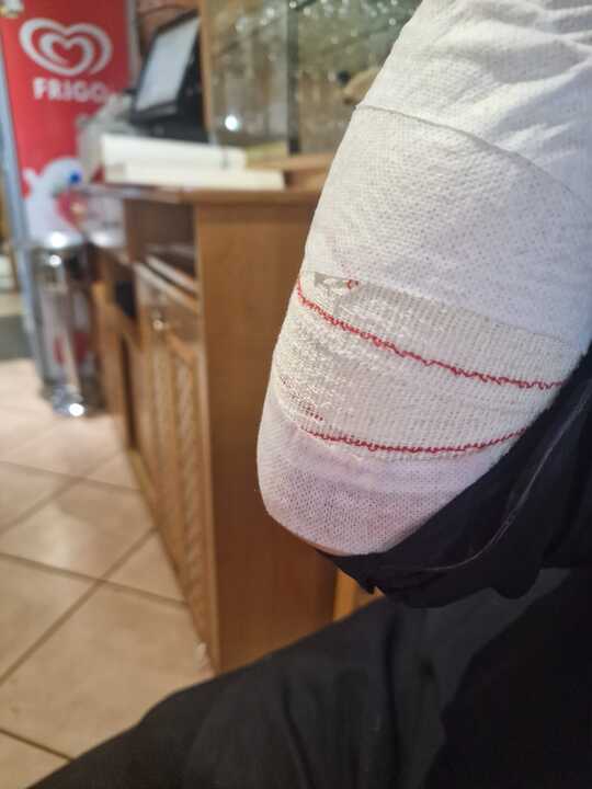 El hostelero Óscar Coca con el brazo vendado