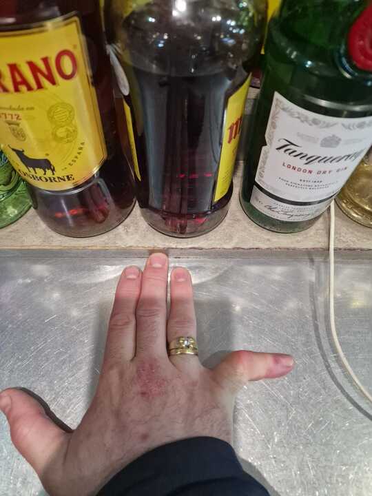 El hostelero Óscar Coca muestra la lesión en el dedo